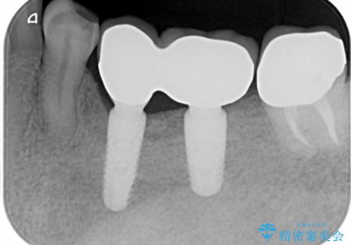 歯牙破折による高度の骨吸収　骨を造成してのインプラント治療の治療後
