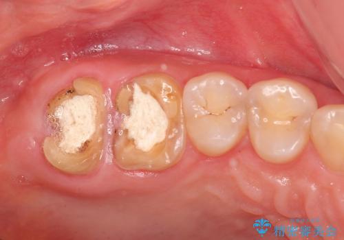 歯冠長延長術を応用した深い虫歯の治療の治療前