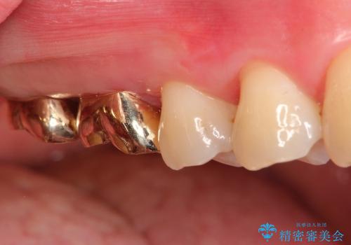 歯冠長延長術を応用した深い虫歯の治療の治療後