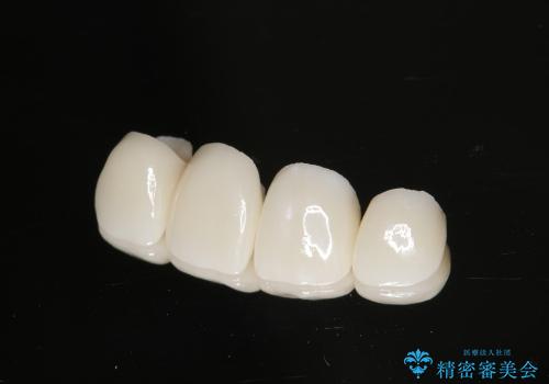 ホワイトニングと前歯のセラミック治療