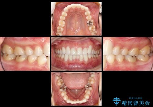 セラミックによる歯並び改善の治療後