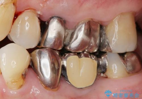 虫歯・歯周病 全体治療の治療前