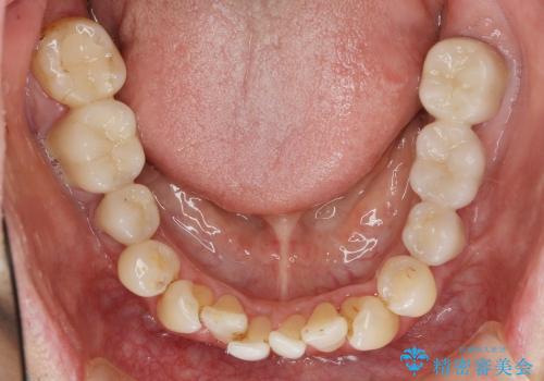 虫歯・歯周病 全体治療の治療後