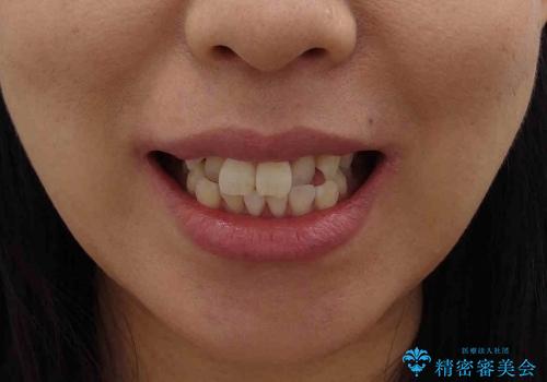 20代女性　前歯のがたがた　八重歯