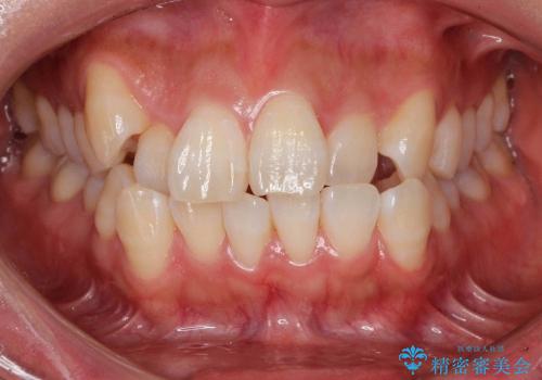 20代女性　前歯のがたがた　八重歯の症例 治療前