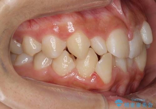 前歯　矯正治療+セラミック治療　矮小(わいしょう)歯の治療前