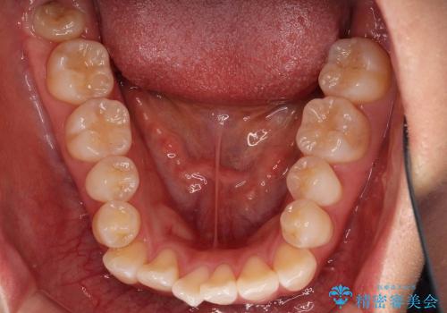 20代女性　前歯のがたがた　八重歯の治療前
