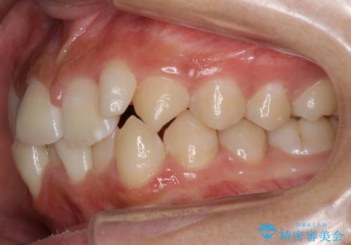 前歯　矯正治療+セラミック治療　矮小(わいしょう)歯の治療前