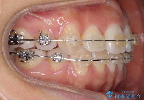 20代女性　前歯のがたがた　八重歯の治療中