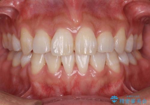 20代女性　前歯のがたがた　八重歯の症例 治療後