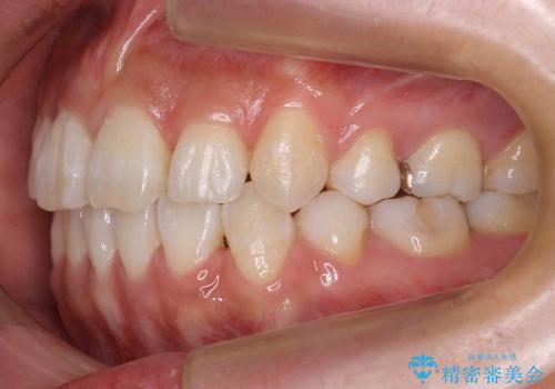20代女性　前歯のがたがた　八重歯の治療後