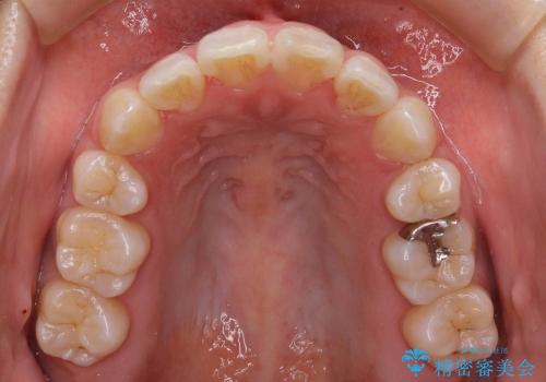 20代女性　前歯のがたがた　八重歯の治療後
