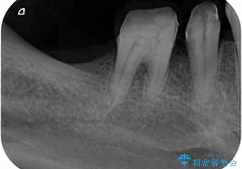 歯周病で失われた奥歯の骨の再生治療の治療後