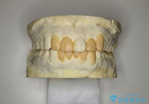 セラミックによる歯並び改善の治療中
