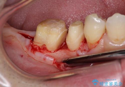 歯周病で失われた奥歯の骨の再生治療の治療後