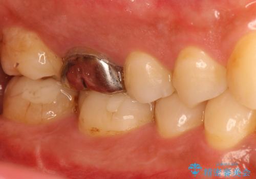 下顎の奥歯の虫歯のセラミックによる治療の治療後