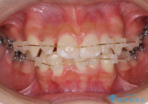 前歯　矯正治療+セラミック治療　矮小(わいしょう)歯の治療中