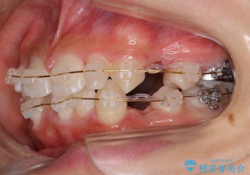 前歯　矯正治療+セラミック治療　矮小(わいしょう)歯の治療中