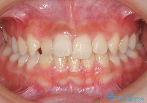 マウスピース矯正　前歯の矯正の症例 治療前