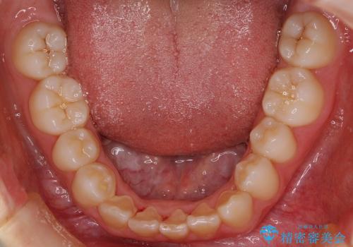 マウスピース矯正　前歯の矯正の治療前