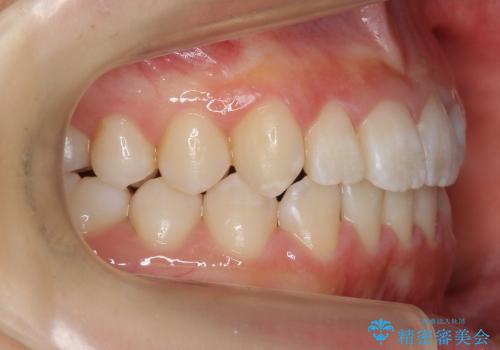 マウスピース矯正　前歯の矯正の治療後