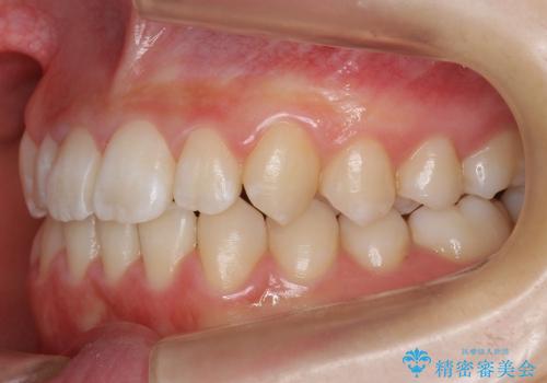 マウスピース矯正　前歯の矯正の治療後