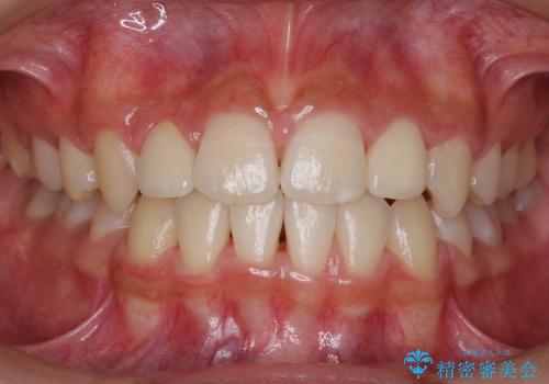 前歯　矯正治療+セラミック治療　矮小(わいしょう)歯の症例 治療後