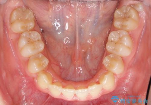 前歯　矯正治療+セラミック治療　矮小(わいしょう)歯の治療後