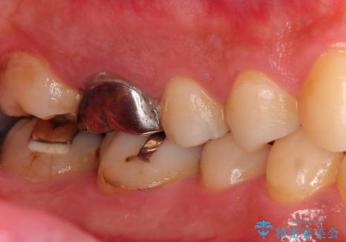 下顎の奥歯の虫歯のセラミックによる治療の治療前