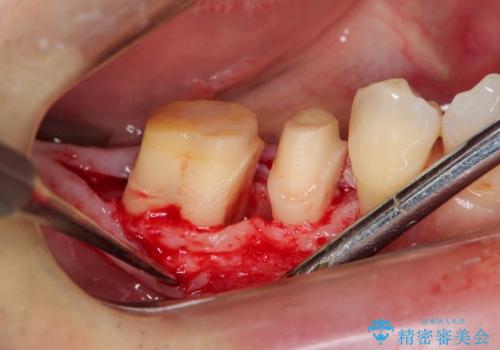 歯周病で失われた奥歯の骨の再生治療の治療前