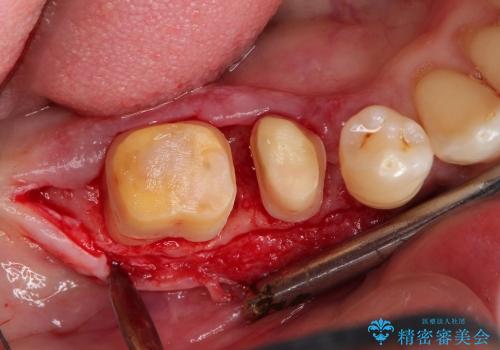 歯周病で失われた奥歯の骨の再生治療の治療前