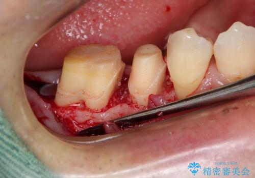 歯周病で失われた奥歯の骨の再生治療の治療中