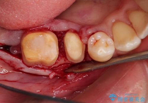 歯周病で失われた奥歯の骨の再生治療の治療中