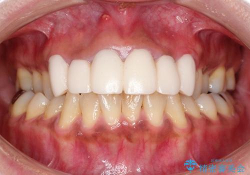 30代女性　前歯のセラミック、土台からしっかりとの治療前