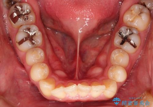 下顎の奥歯の虫歯のセラミックによる治療の治療前