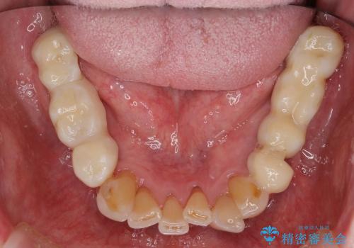 入れ歯をはずす全顎的インプラント治療の治療中