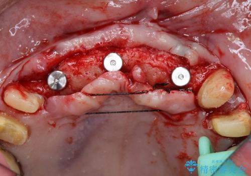 入れ歯をはずす全顎的インプラント治療の治療中