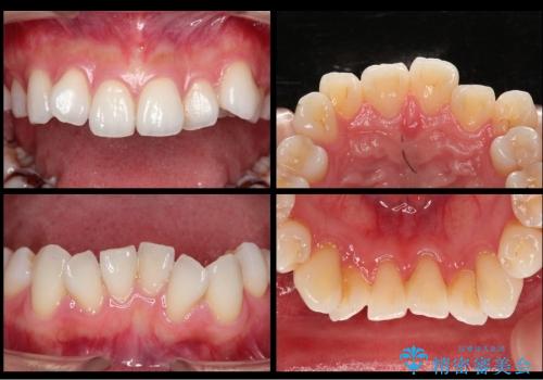 セラミックによる歯並び改善の治療前