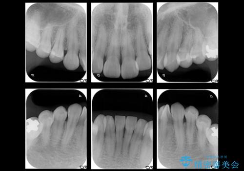 セラミックによる歯並び改善の治療前