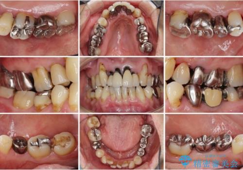 虫歯・歯周病 全体治療の症例 治療前