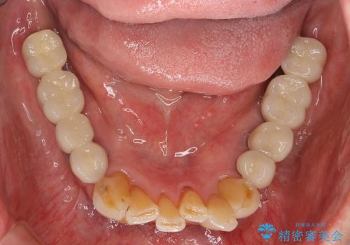 入れ歯をはずす全顎的インプラント治療の治療後