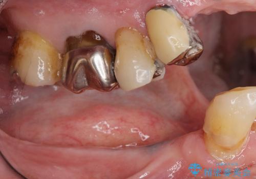 入れ歯をはずす全顎的インプラント治療の治療前