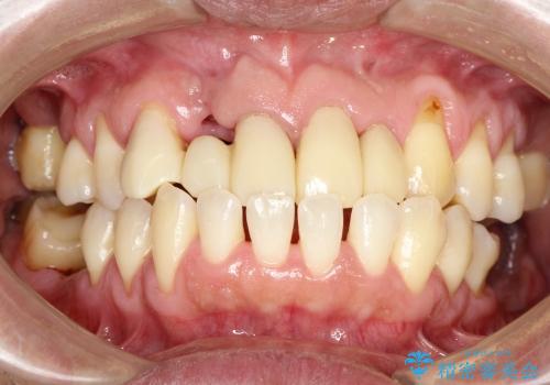 前歯　深い虫歯の治療の治療中