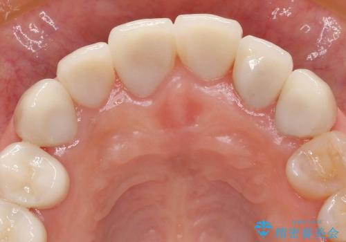 [変色歯・テトラサイクリン歯]  ジルコニアクラウンによる審美改善の治療後