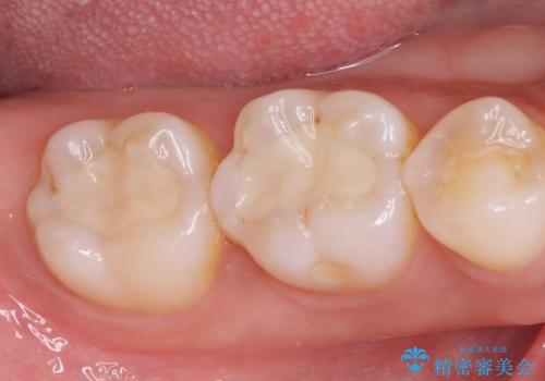 30代女性　奥歯の銀歯をセラミックで白い歯にの治療後