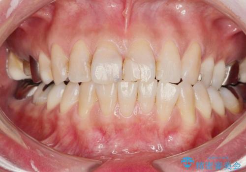 [金属アレルギー] 銀歯を外すセラミック審美歯科治療の治療前
