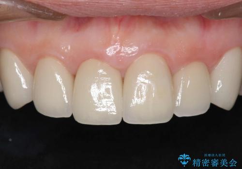 [変色歯・テトラサイクリン歯]  ジルコニアクラウンによる審美改善の治療後