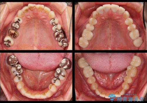 [金属アレルギー] 銀歯を外すセラミック審美歯科治療
