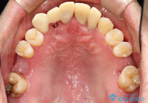 前歯　深い虫歯の治療の治療中