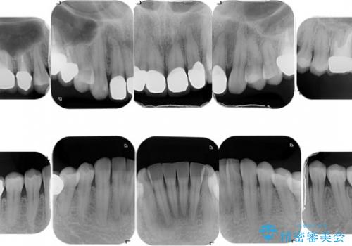 [金属アレルギー] 銀歯を外すセラミック審美歯科治療の治療後
